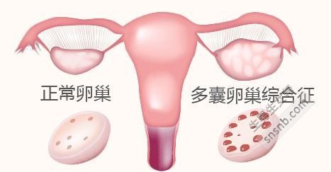 多囊卵巢综合征的诊断标准是什么？它能引起哪些并发症？