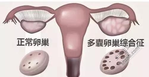 ＂多囊卵巢 ＂和 ＂多囊卵巢综合症 ＂是一回事吗？