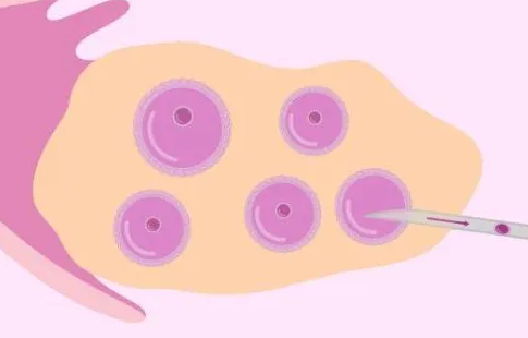 太原助孕群：摘除空卵泡的原因是它太早了吗？
